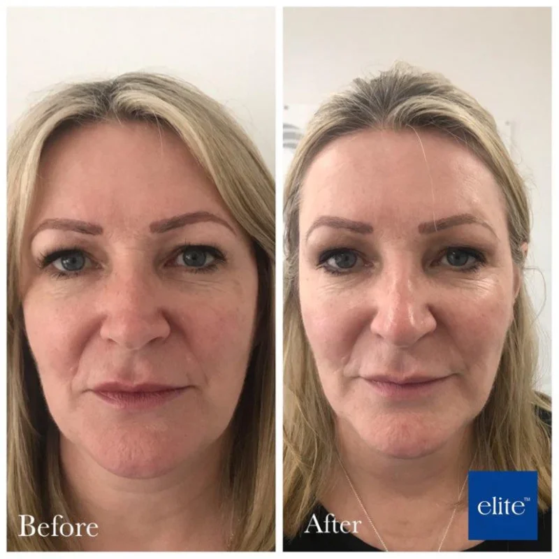 profhilo before and after